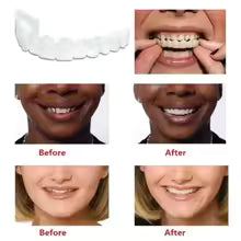 Snap-In Teeth – Instant Perfect Smile Without Dentist